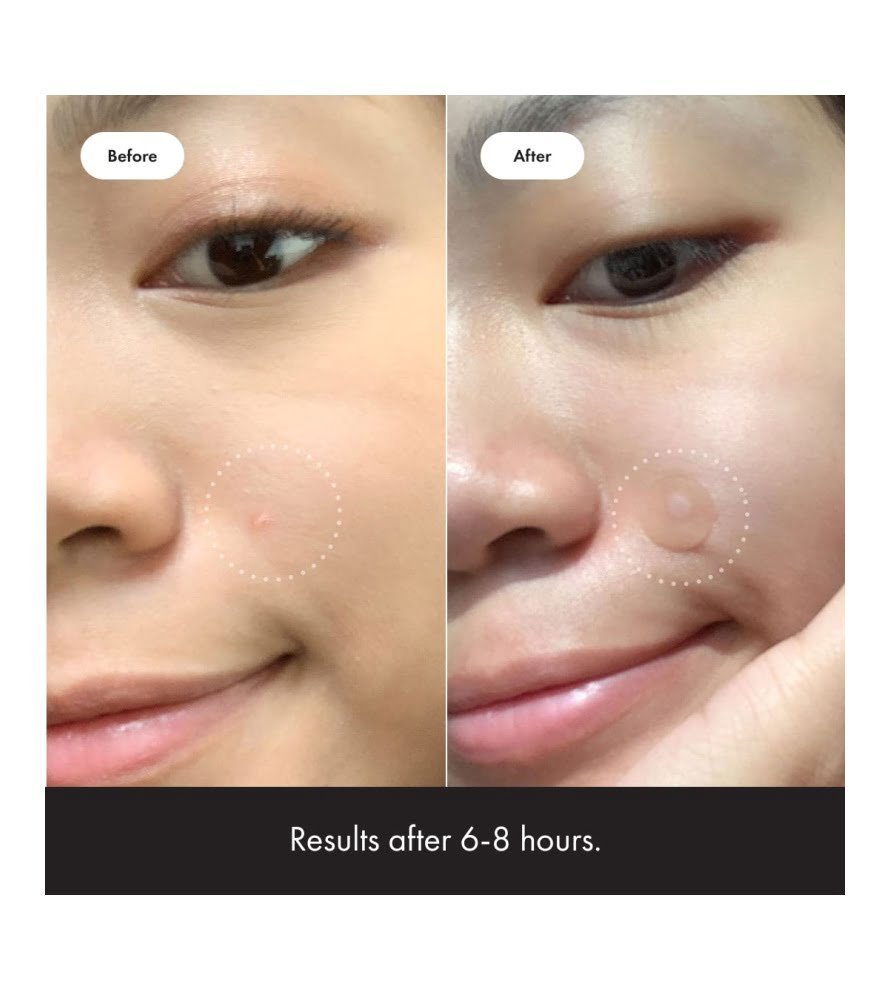 Mighty Patch Original from Hero Cosmetics ?C Hydrocolloid Acne Pimple Patch for Covering Zits and Blemishes. Spot Stickers for Face and Skin. Vegan-friendly and Not Tested on Animals (36 Count) - Image 4